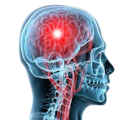 Stroke Detection and Response